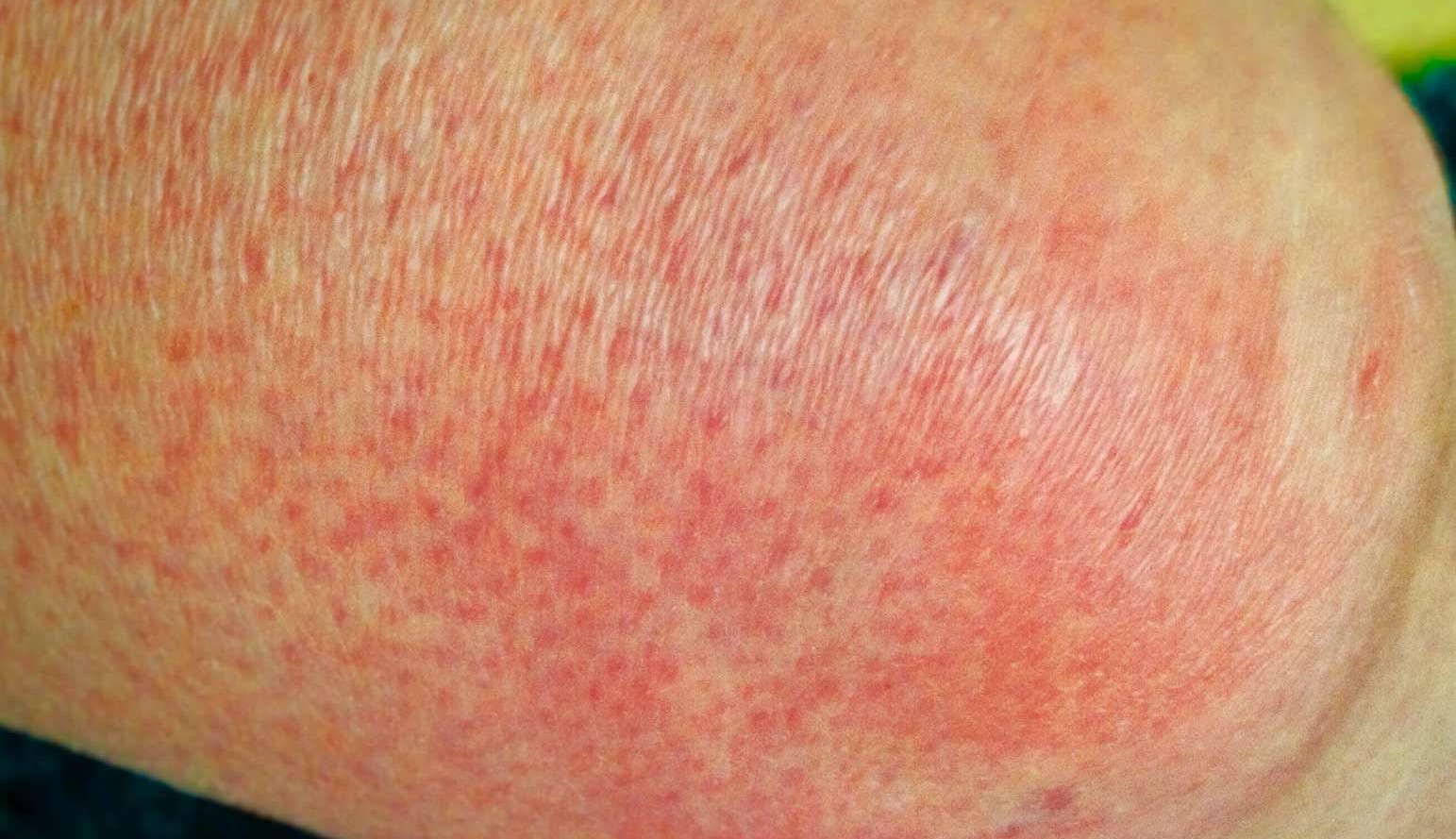 Selulitas